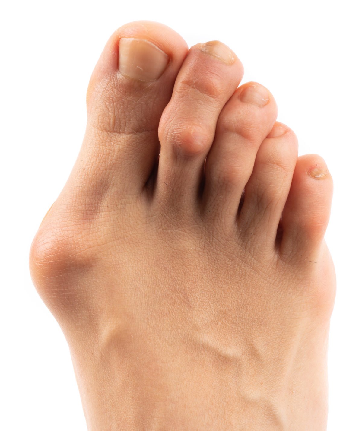 A woman with a bunion being treated at Canyon Oaks Foot and Ankle