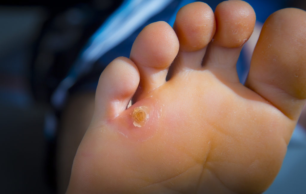 Plantar callus removal: how to get rid of calluses on feet permanently?