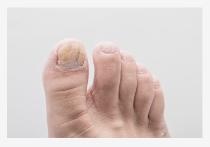 How Long Should Toenails Be | Foot Doctor Marietta And Atlanta GA