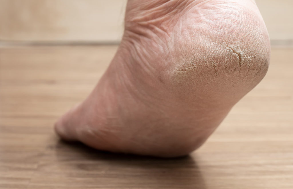 here is how to fix deep heel fissures or dry heel fissures