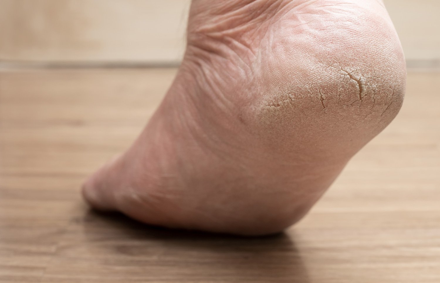 सूखी और फटी एड़ियों का ईलाज || Treatment of Dry and Cracked Heels (In  HINDI) - YouTube