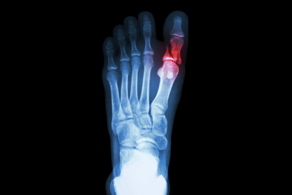 an example of fractured toes and showing signs of broken toe