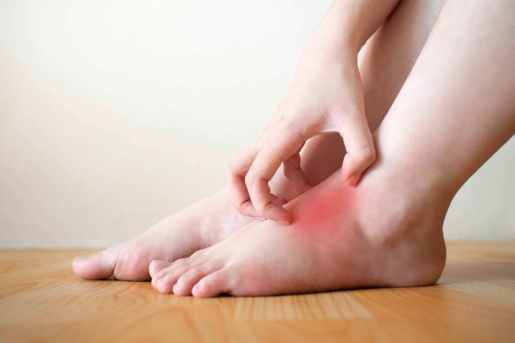 Diabetic foot rash example