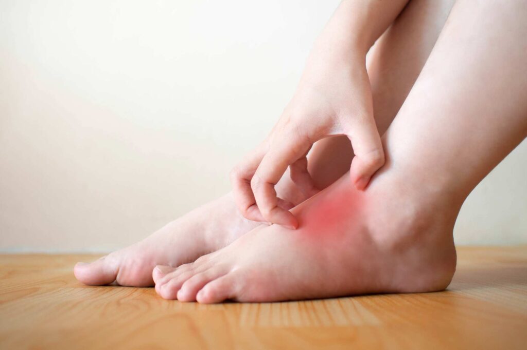 Diabetic foot rash example