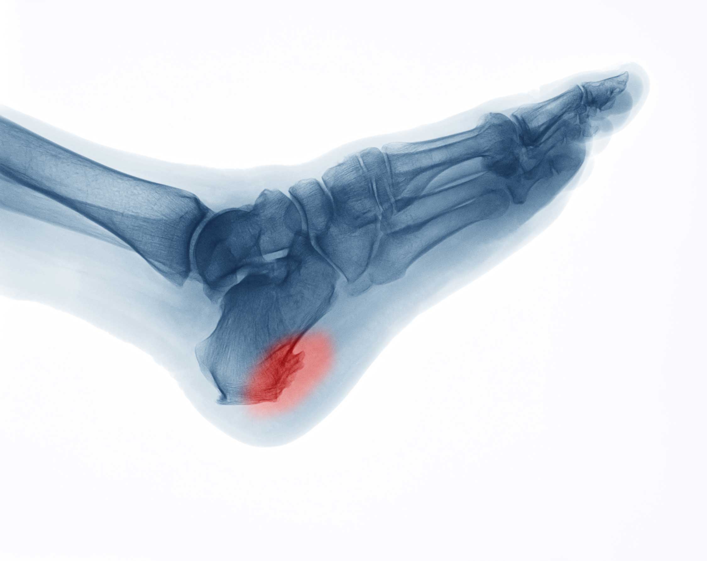 What Are Heel Spurs? | Causes & Treatments | Red Mountain Footcare