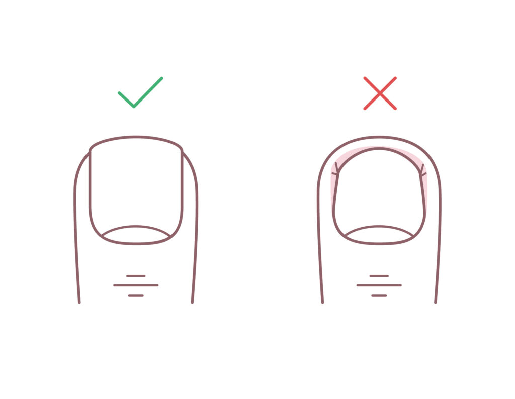 an illustration of Toenail Injuries